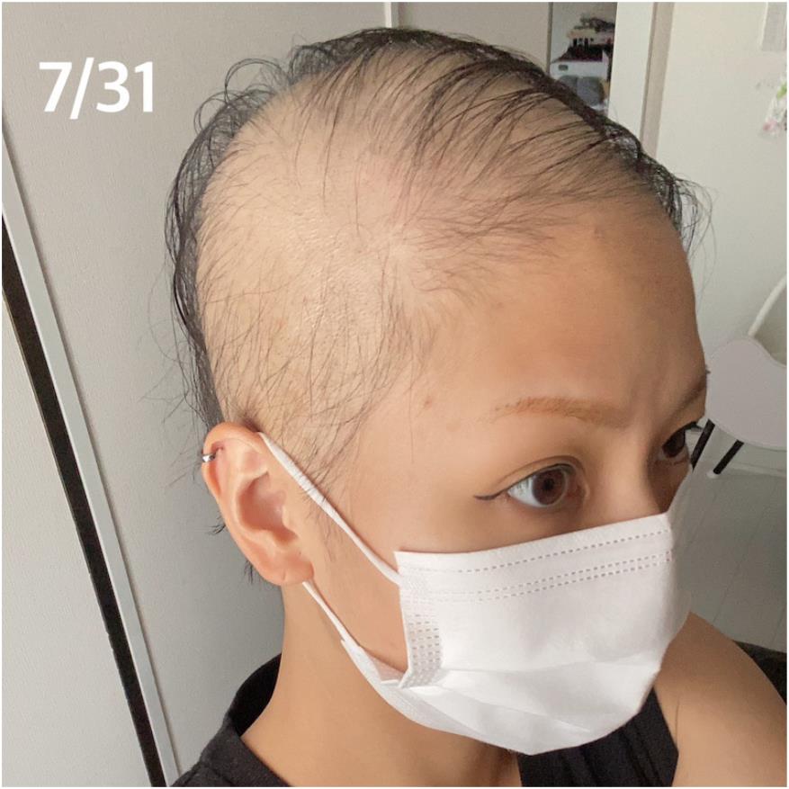她7月中开始购买假发，右为21日掉发状况