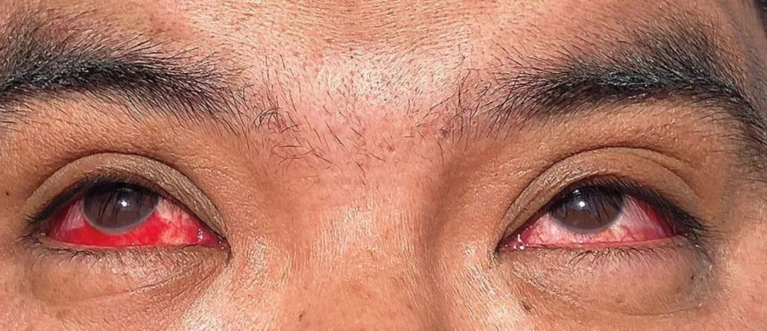 一名牧场工人出现眼部红肿