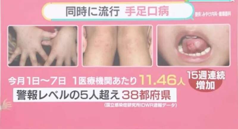 同时流行手口足病